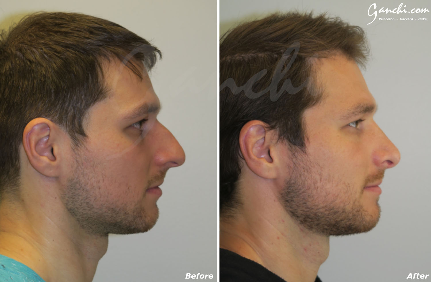 Rhinoplasty Before and After Photo by Ganchi Plastic Surgery in Northern New Jersey