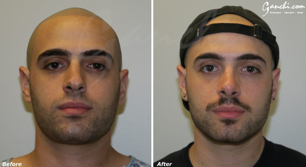 Rhinoplasty Before and After Photo by Ganchi Plastic Surgery in Northern New Jersey