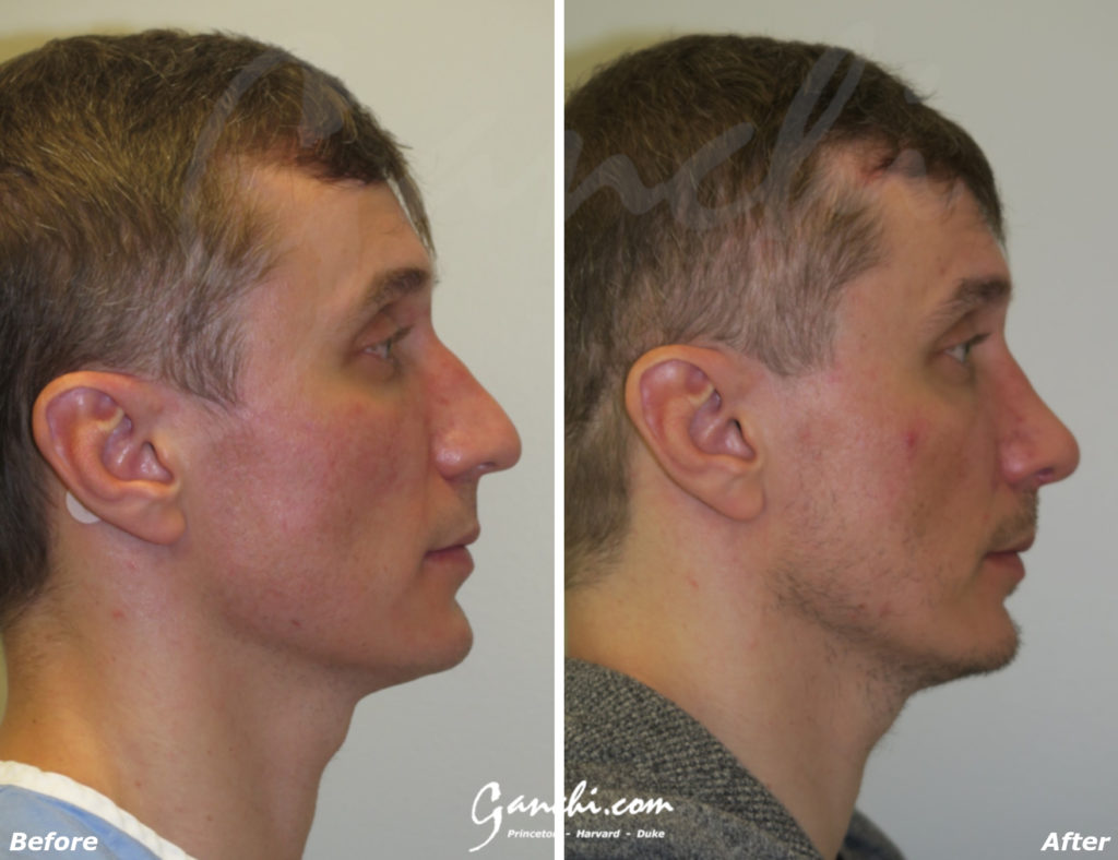 Rhinoplasty Before and After Photo by Ganchi Plastic Surgery in Northern New Jersey