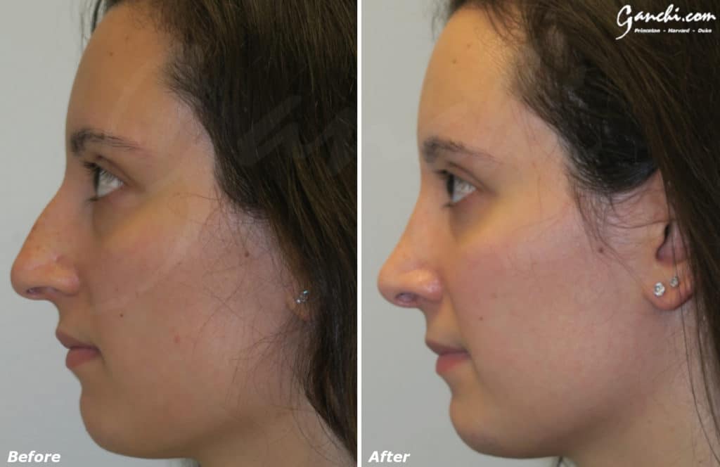 Rhinoplasty Before and After Photo by Ganchi Plastic Surgery in Northern New Jersey