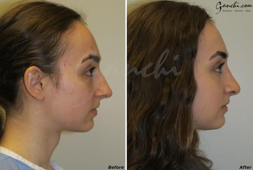 Rhinoplasty Before and After Photo by Ganchi Plastic Surgery in Northern New Jersey