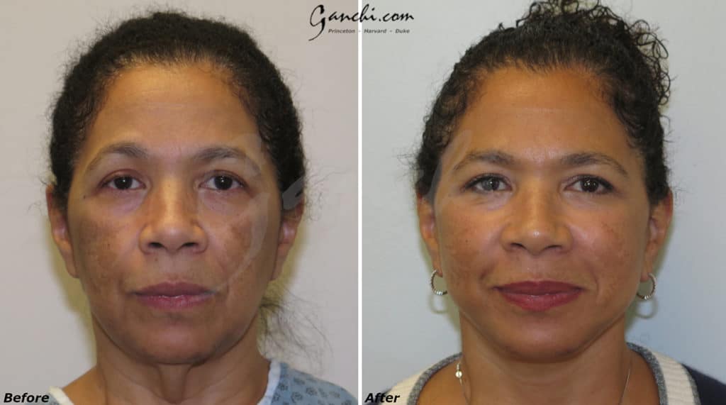 Facelift Before and After Photo by Ganchi Plastic Surgery in Northern New Jersey