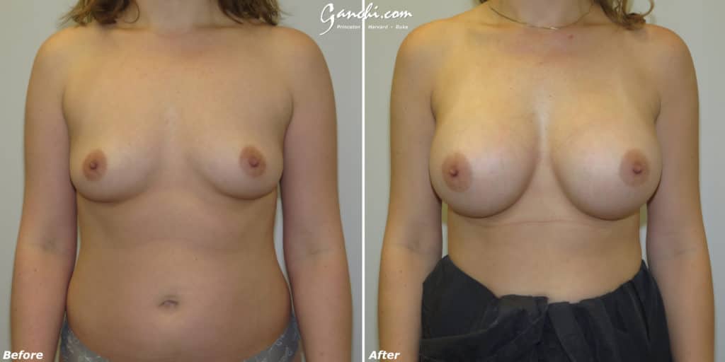 Breast Augmentation Before and After Photo by Ganchi Plastic Surgery in Northern New Jersey