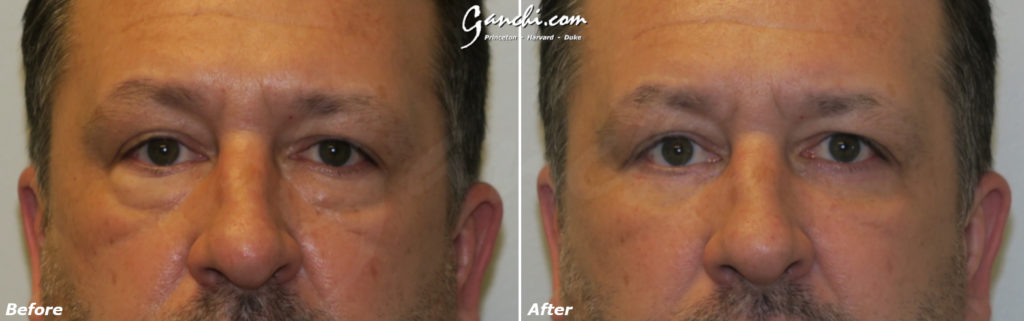 Eyelid Lift Before and After Photo by Ganchi Plastic Surgery in Northern New Jersey