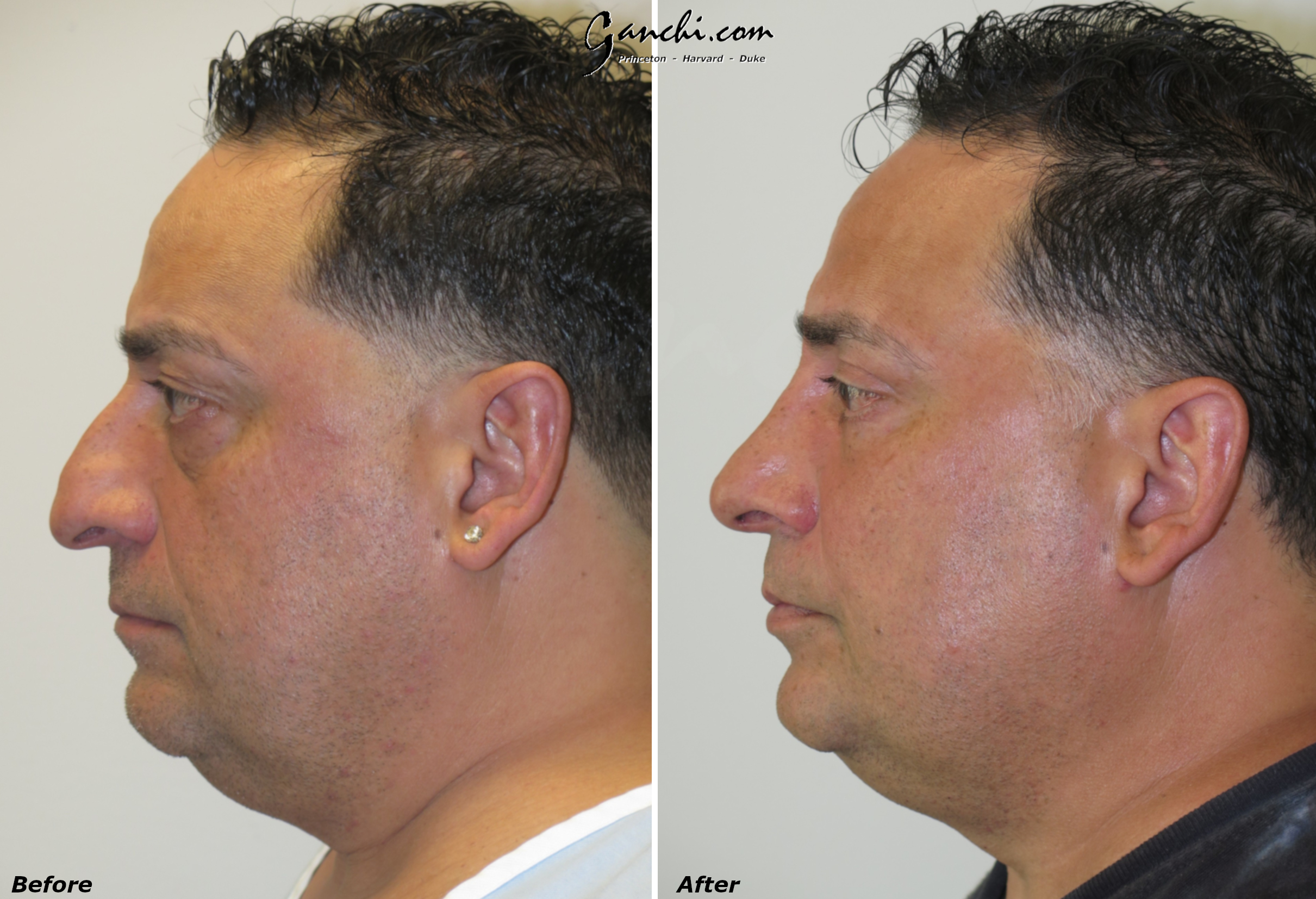 Rhinoplasty (Nose) Before and After Photo by Ganchi Plastic Surgery in Northern New Jersey