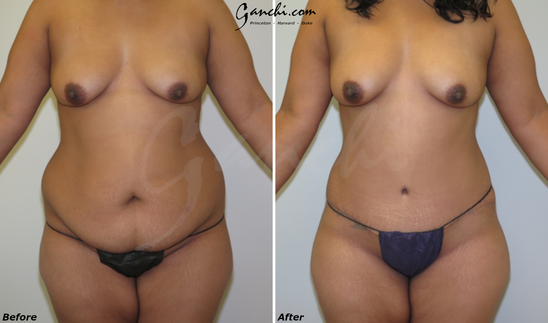 Abdominoplasty (Tummy Tuck) Before and After Photo by Ganchi Plastic Surgery in Northern New Jersey