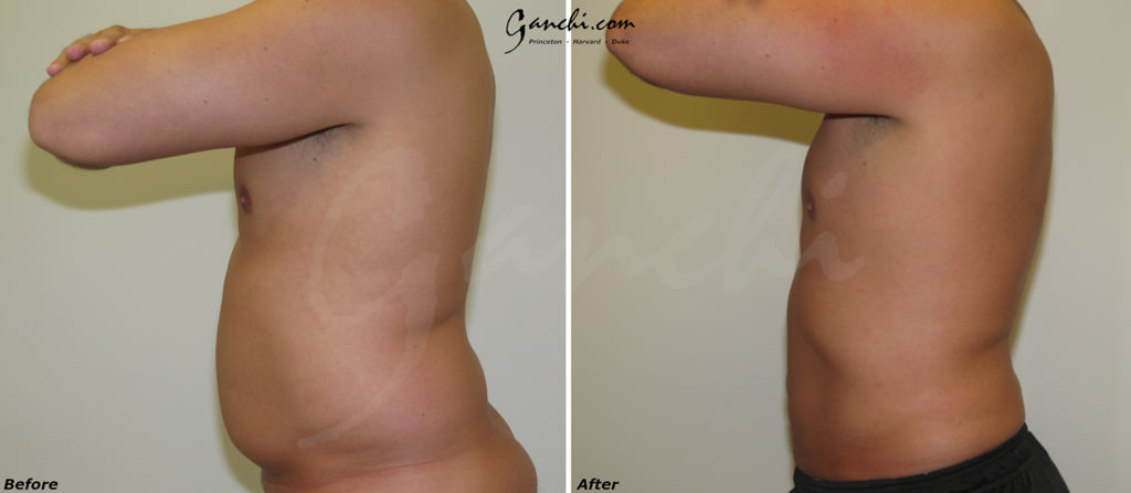 Liposuction Before and After Photo by Ganchi Plastic Surgery in Northern New Jersey