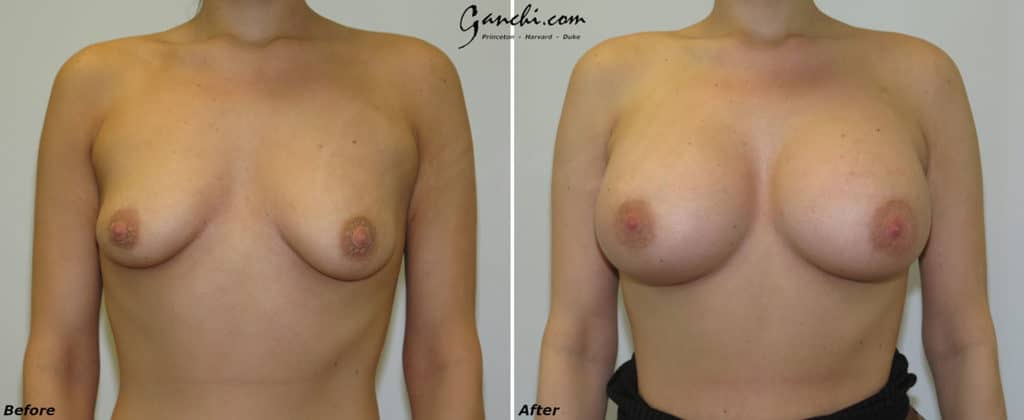 Breast Augmentation Before and After Photo by Ganchi Plastic Surgery in Northern New Jersey