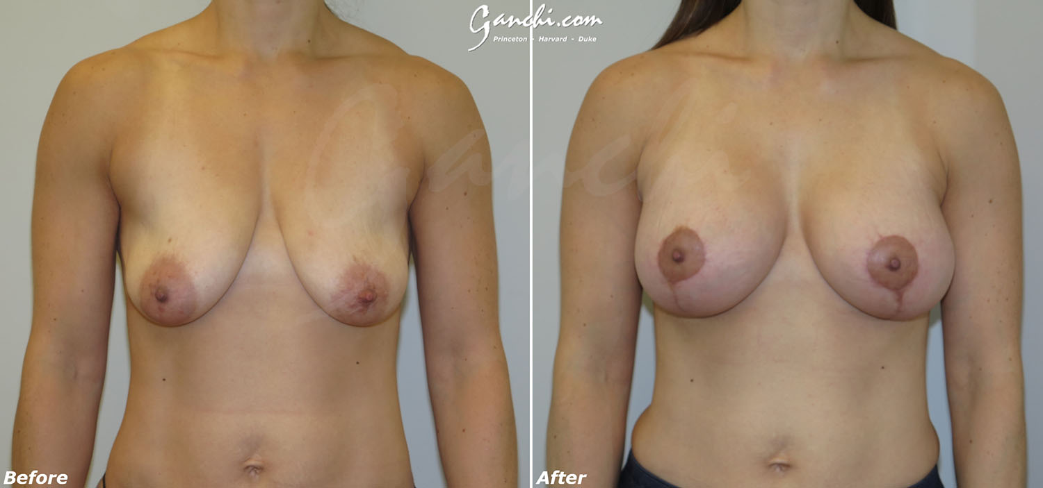 Breast Lift Before and After Photo by Ganchi Plastic Surgery in Northern New Jersey