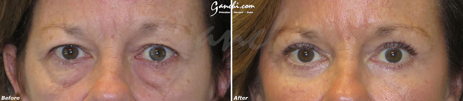 Eyelid Lift Before and After Photo by Ganchi Plastic Surgery in Northern New Jersey