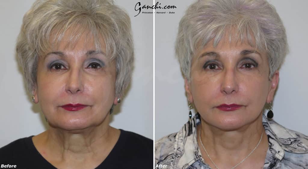Face/Neck Lift Before and After Photo by Ganchi Plastic Surgery in Northern New Jersey
