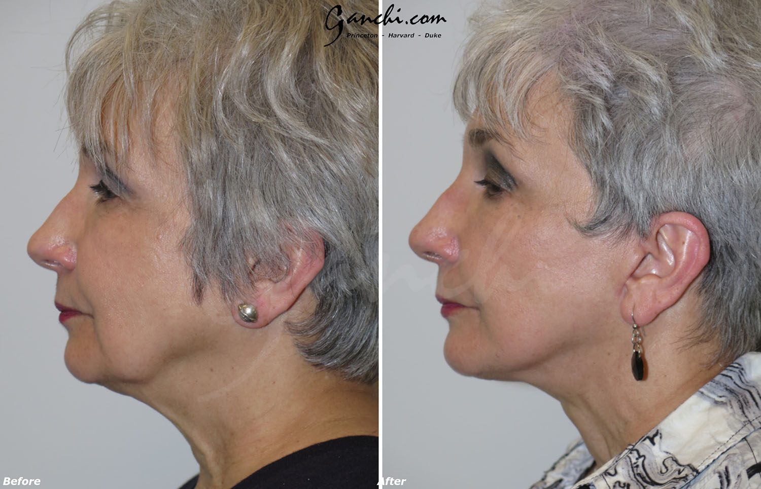 Face/Neck Lift Before and After Photo by Ganchi Plastic Surgery in Northern New Jersey