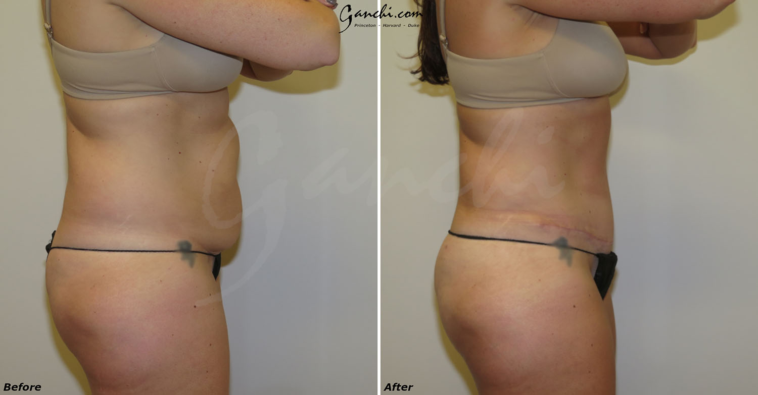 Tummy Tuck Before and After Photo by Ganchi Plastic Surgery in Northern New Jersey