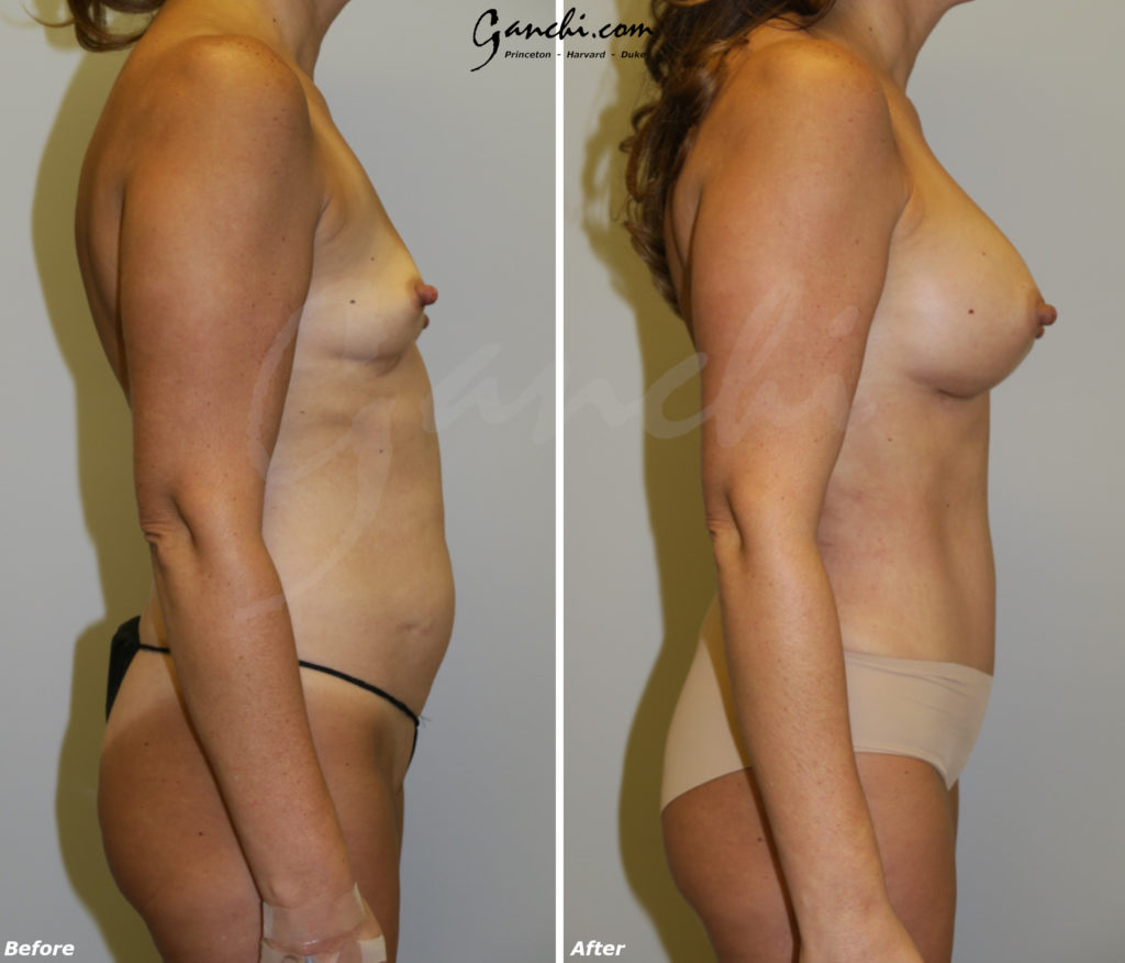 Mommy Makeover Before and After Photo by Ganchi Plastic Surgery in Northern New Jersey