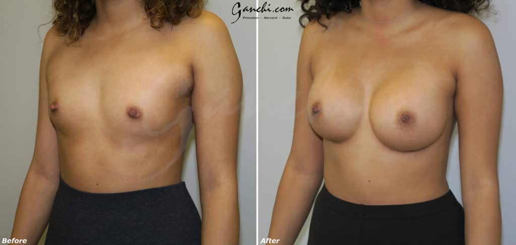 Breast Augmentation Before and After Photo by Ganchi Plastic Surgery in Northern New Jersey