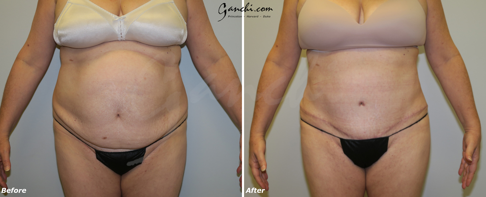 Abdominoplasty Before and After Photo by Ganchi Plastic Surgery in Northern New Jersey