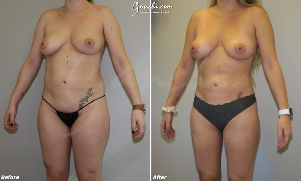 Liposuction Before and After Photo by Ganchi Plastic Surgery in Northern New Jersey