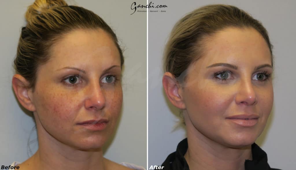 Rhinoplasty Before and After Photo by Ganchi Plastic Surgery in Northern New Jersey