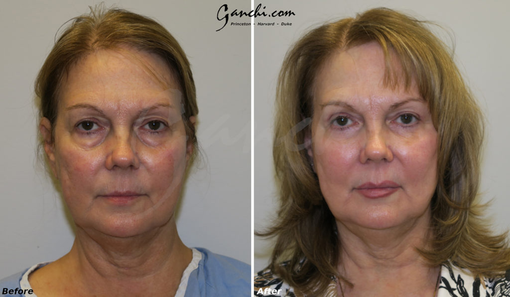 Eyelid & Lip Augmentation Before and After Photo by Ganchi Plastic Surgery in Northern New Jersey
