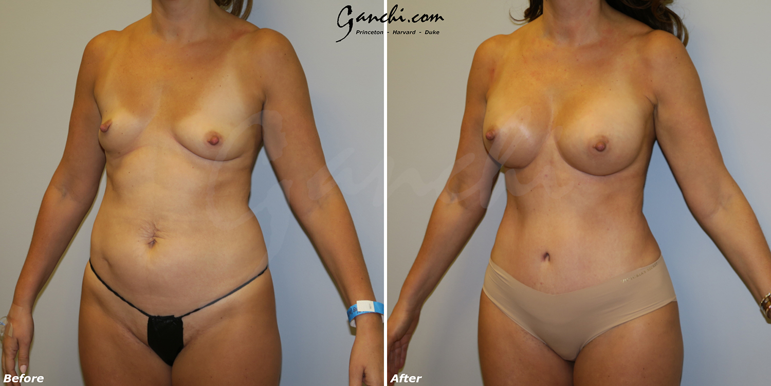 Mommy Makeover & Adbominoplasty Before and After Photo by Ganchi Plastic Surgery in Northern New Jersey