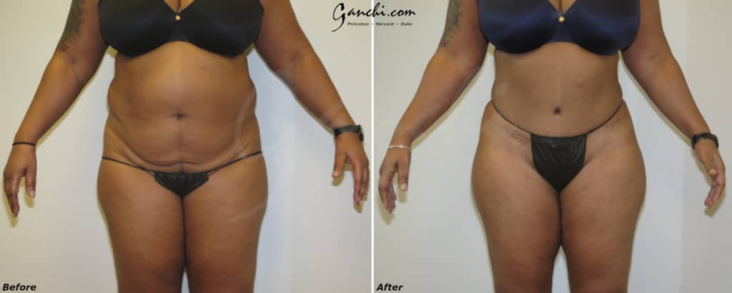 Adbominoplasty Before and After Photo by Ganchi Plastic Surgery in Northern New Jersey