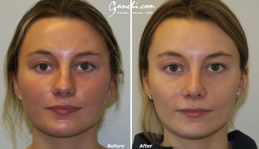 Rhinoplasty Before and After Photo by Ganchi Plastic Surgery in Northern New Jersey