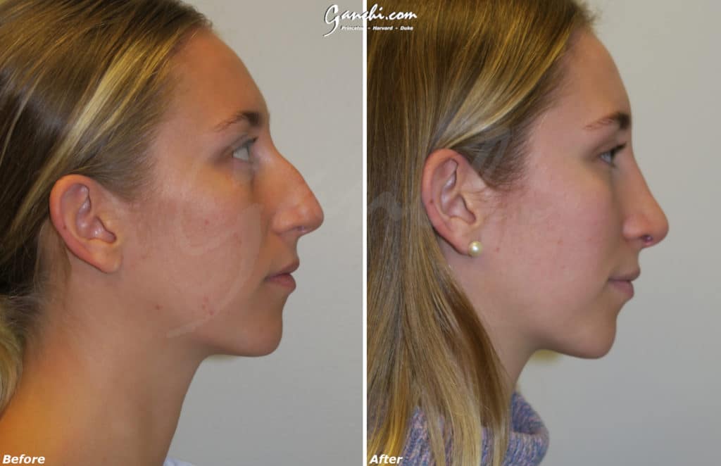 Rhinoplasty Before and After Photo by Ganchi Plastic Surgery in Northern New Jersey