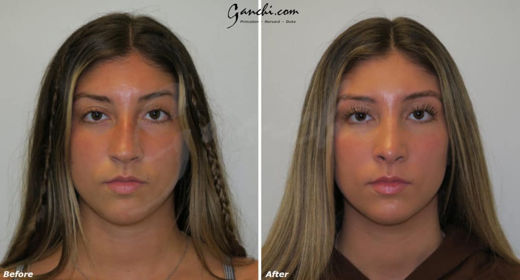 Rhinoplasty Before and After Photo by Ganchi Plastic Surgery in Northern New Jersey