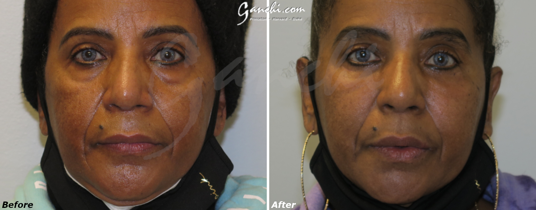Eyelid lift Before & after
