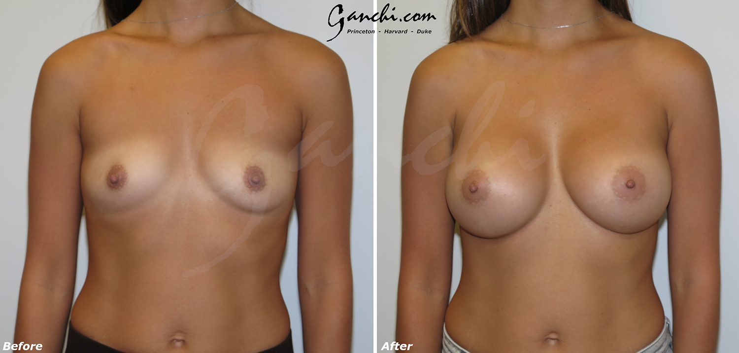 Breast Augmentation Before and After Photo by Ganchi Plastic Surgery in Northern New Jersey