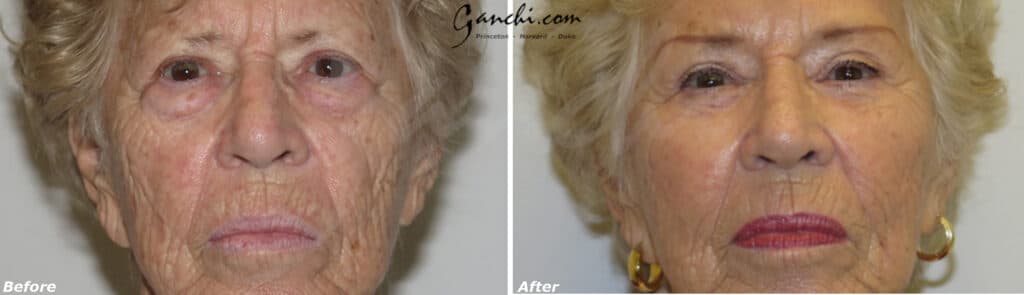 Eyelid Lift Before and After Photo by Ganchi Plastic Surgery in Northern New Jersey