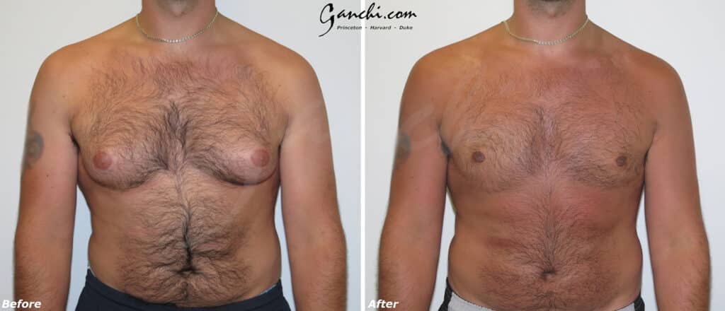Gynecomastia Before and After Photo by Ganchi Plastic Surgery in Northern New Jersey