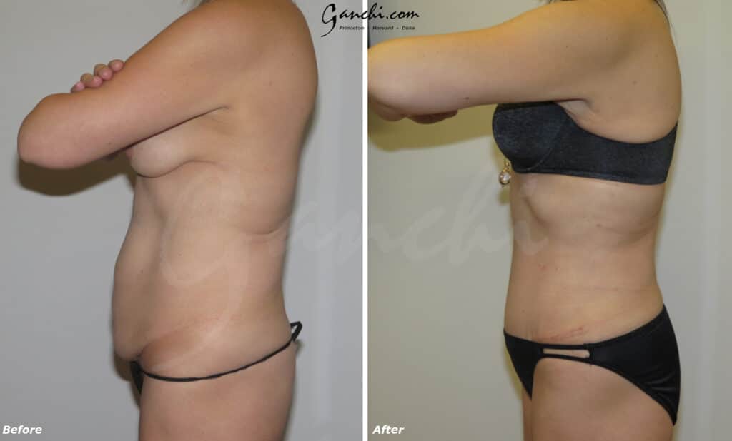 Abdominoplasty Before and After Photo by Ganchi Plastic Surgery in Northern New Jersey