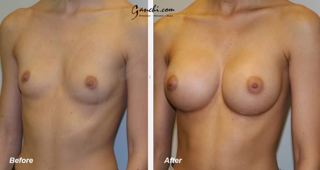 Breast Augmentation Before and After Photo by Ganchi Plastic Surgery in Northern New Jersey