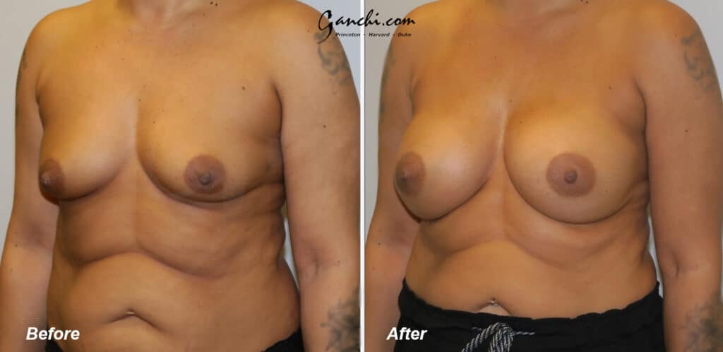 Breast Augmentation Before and After Photo by Ganchi Plastic Surgery in Northern New Jersey