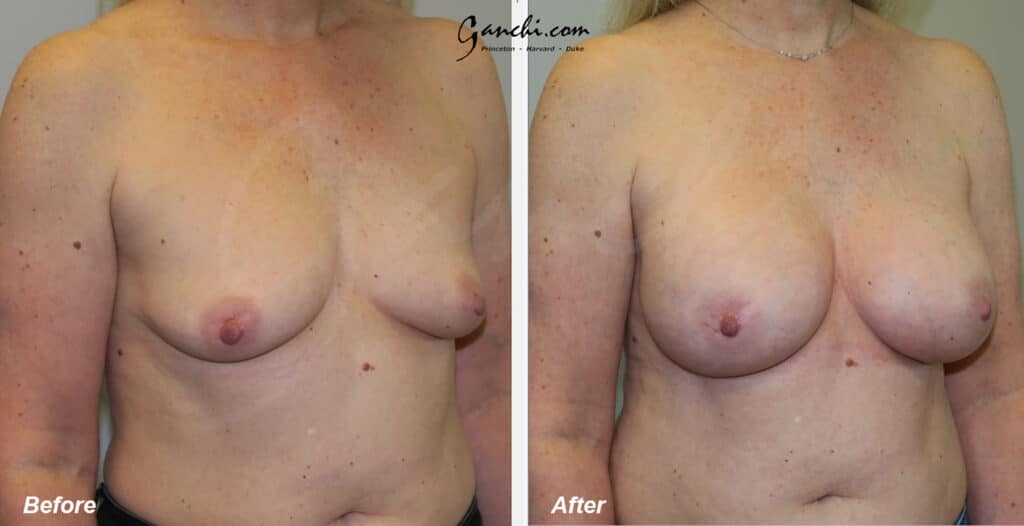 Breast Augmentation Before and After Photo by Ganchi Plastic Surgery in Northern New Jersey