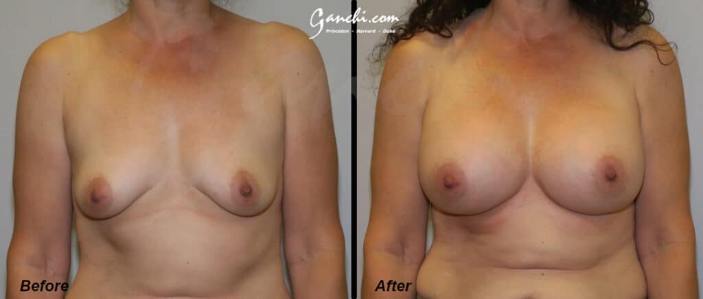 Breast Augmentation Before and After Photo by Ganchi Plastic Surgery in Northern New Jersey
