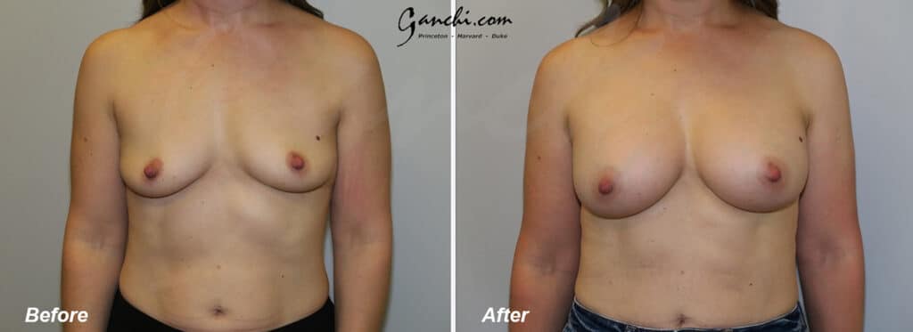 Breast Augmentation Before and After Photo by Ganchi Plastic Surgery in Northern New Jersey