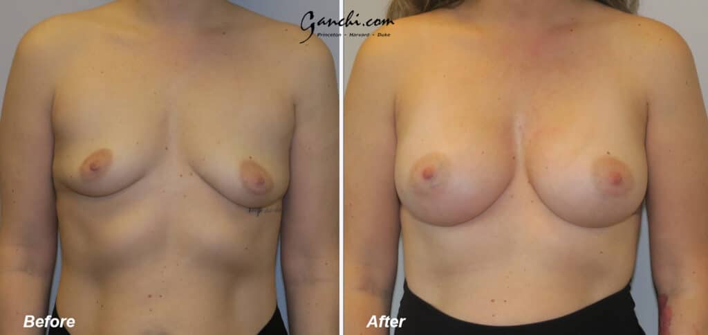 Breast Augmentation Before and After Photo by Ganchi Plastic Surgery in Northern New Jersey