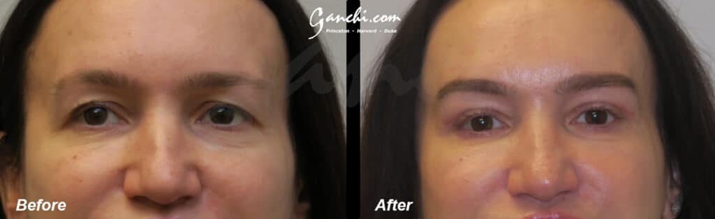 Eyelid Lift Before and After Photo by Ganchi Plastic Surgery in Northern New Jersey