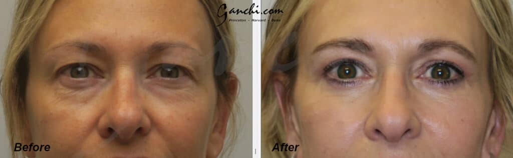 Eyelid Lift Before and After Photo by Ganchi Plastic Surgery in Northern New Jersey