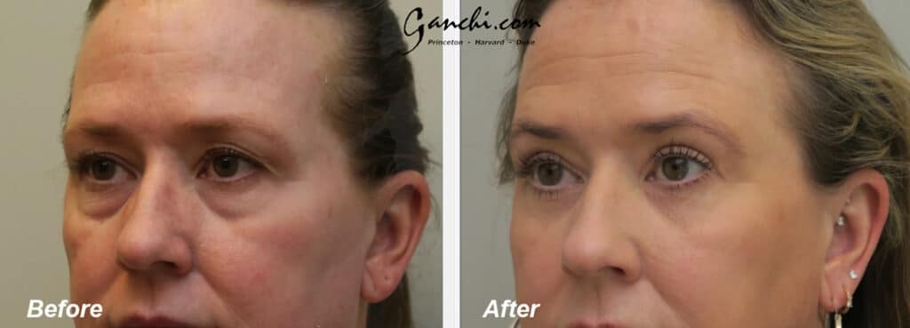Eyelid Lift Before and After Photo by Ganchi Plastic Surgery in Northern New Jersey