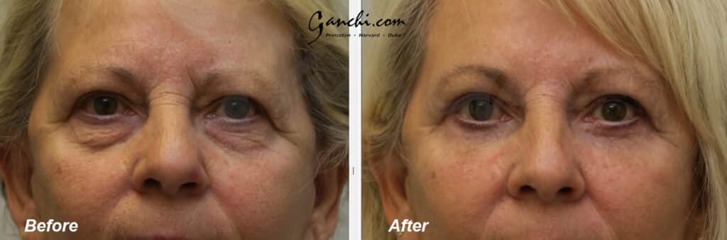 Eyelid Lift Before and After Photo by Ganchi Plastic Surgery in Northern New Jersey