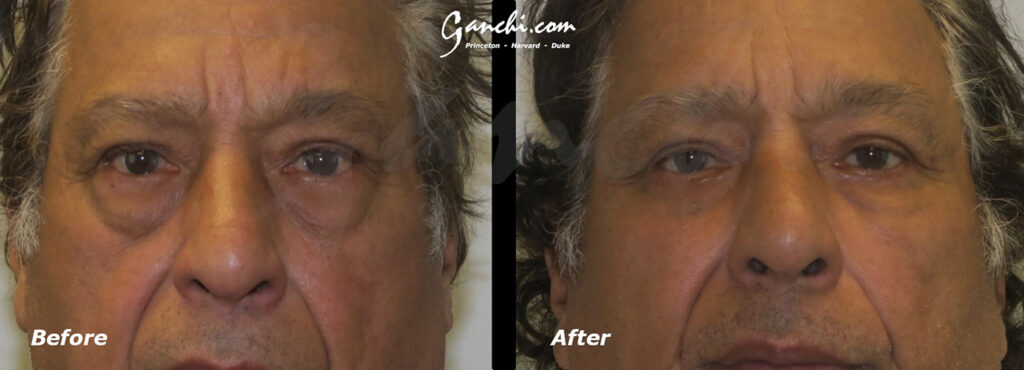 Eyelid Lift Before and After Photo by Ganchi Plastic Surgery in Northern New Jersey