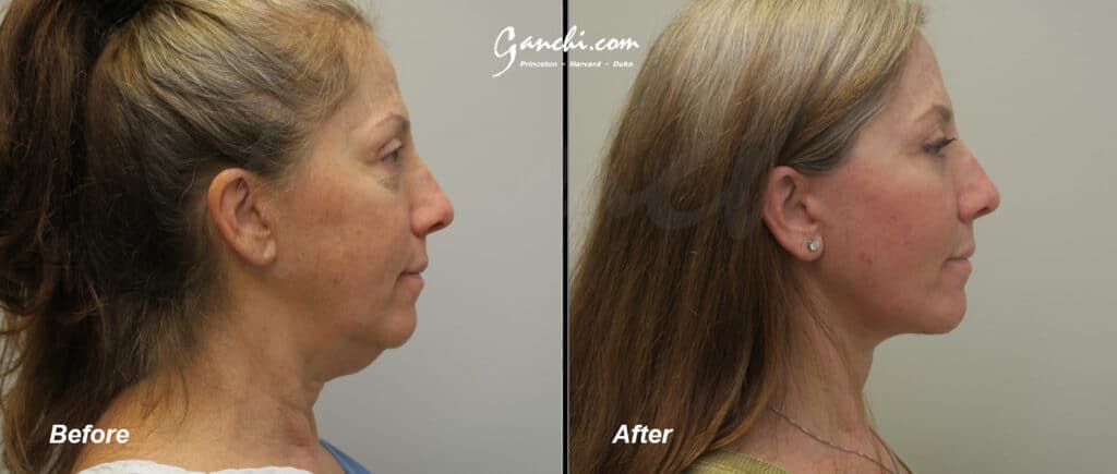 Face/Neck Lift Before and After Photo by Ganchi Plastic Surgery in Northern New Jersey