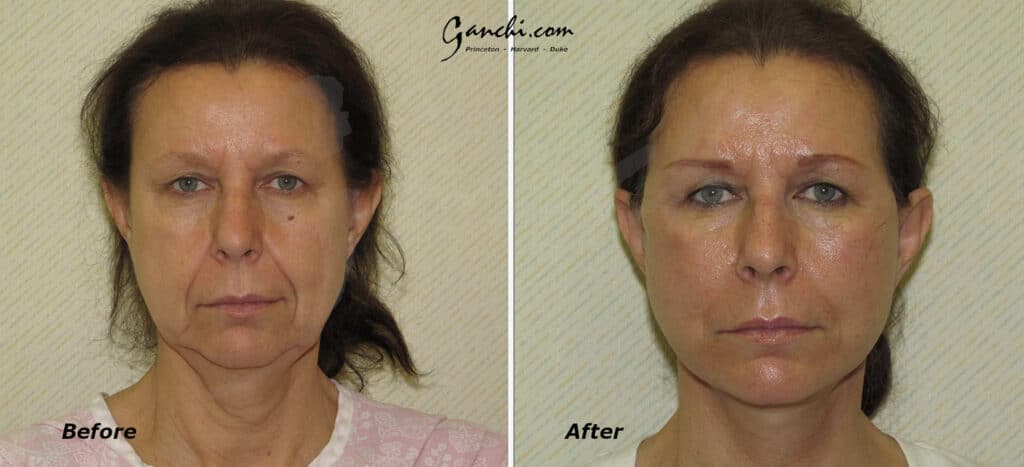 Face/Neck Lift Before and After Photo by Ganchi Plastic Surgery in Northern New Jersey