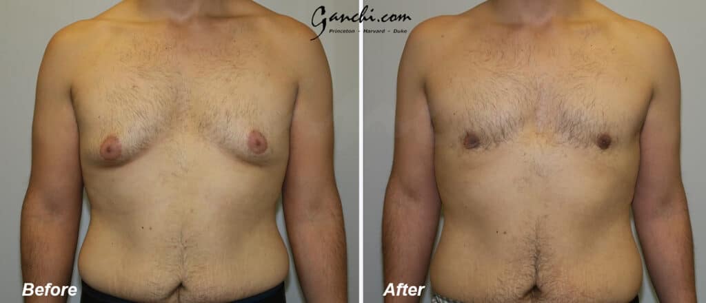 Gynecomastia Before and After Photo by Ganchi Plastic Surgery in Northern New Jersey