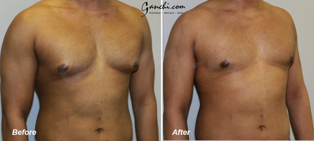 Gynecomastia Before and After Photo by Ganchi Plastic Surgery in Northern New Jersey