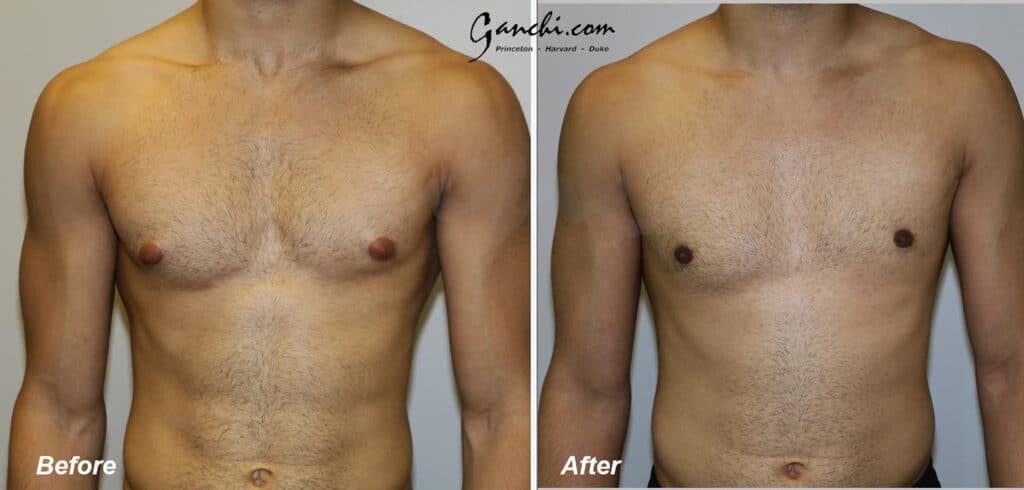 Gynecomastia Before and After Photo by Ganchi Plastic Surgery in Northern New Jersey