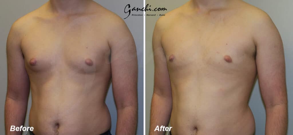 Gynecomastia Before and After Photo by Ganchi Plastic Surgery in Northern New Jersey